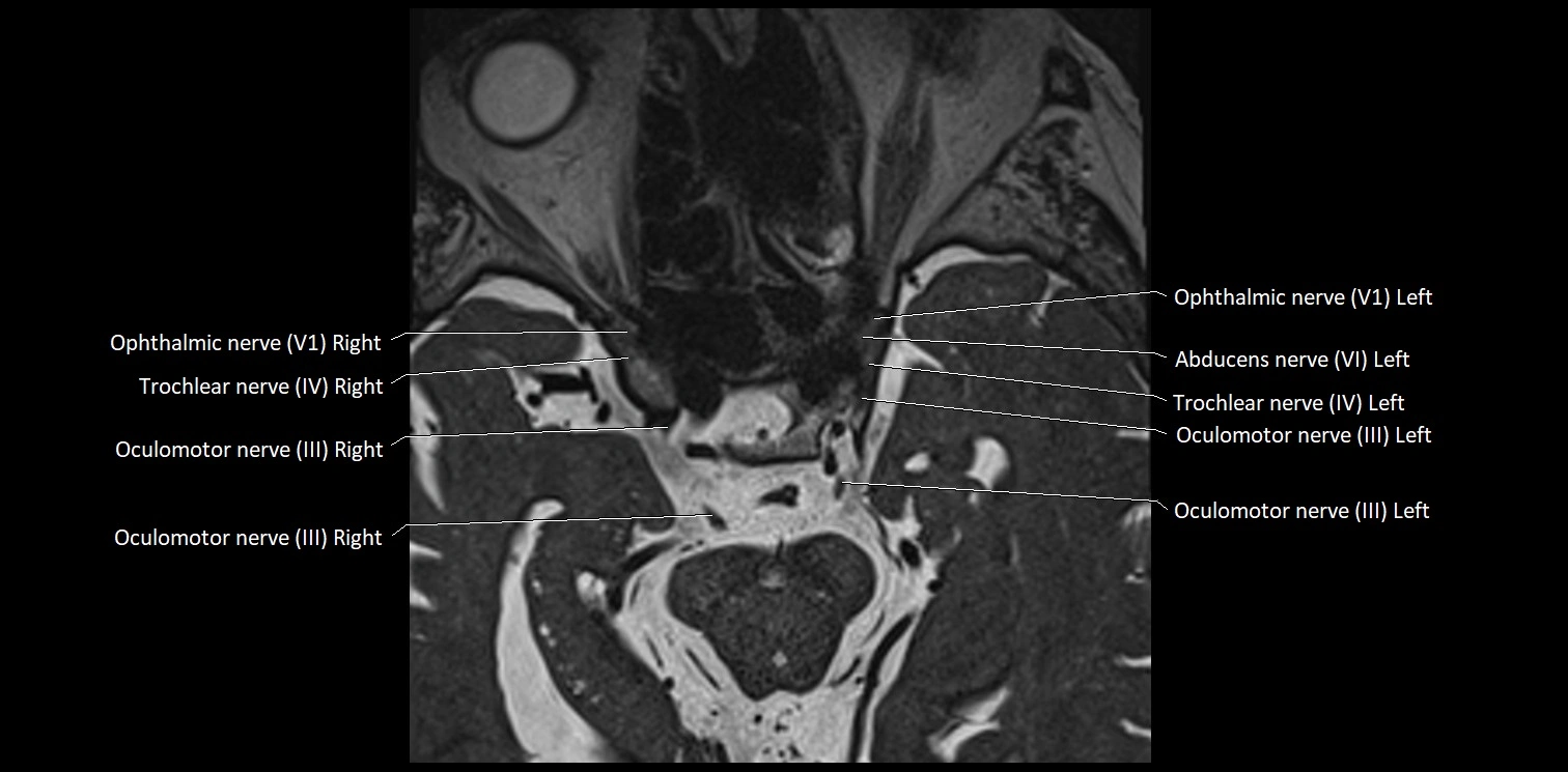 Cranial nerve anatomy axial MRI 3T image 22.webp